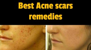 acne scars remedies