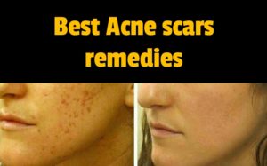 acne scars remedies